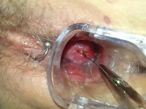 Mirena Spirale loại bỏ ziehen IUD IUP entfernen
