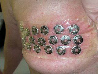 Verwijdering van punaises uit de tieten